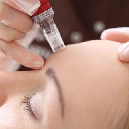 What is micro needling?